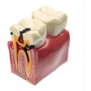 Six times enlarged dental caries tooth model used for study, comparison and patient education, showing tooth decay and its effects.