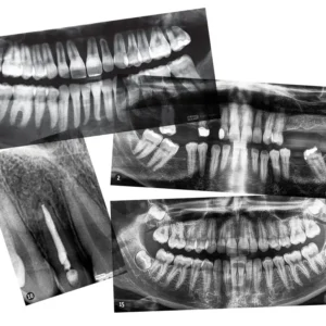 See inside a mouth with these 15 real dental X-rays manufactured by Roylco showing primary and permanent teeth, unhealthy teeth, and mouth injuries on a light panel.